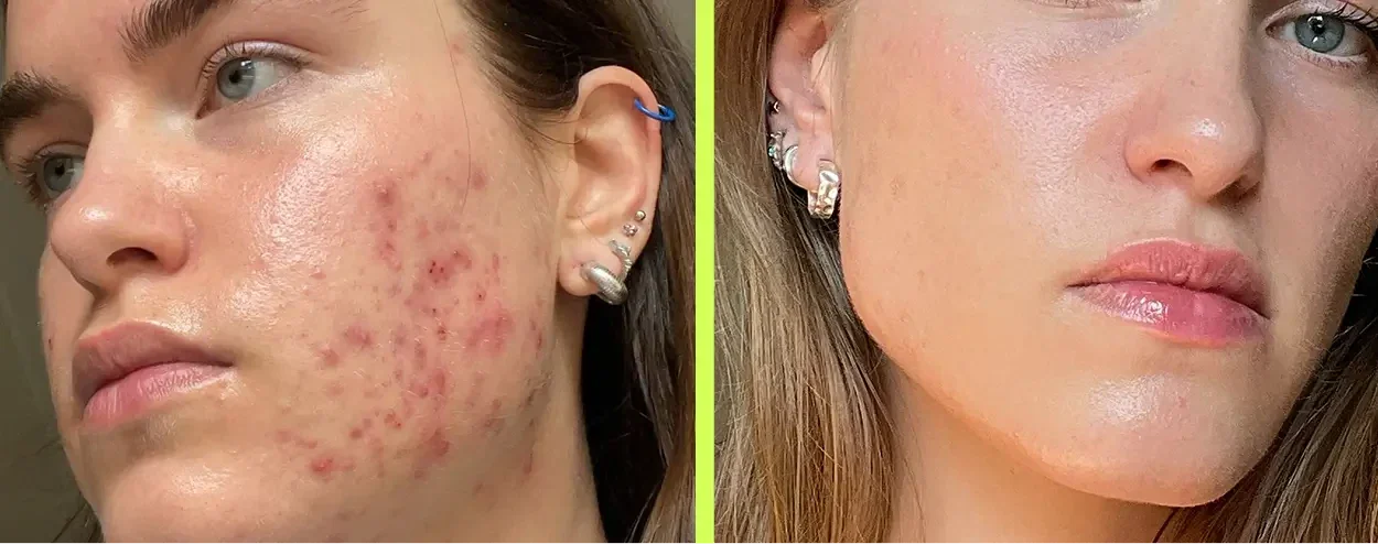 Hormonale acne op kin en kaaklijn vóór, en een rustige egale huid na de aanpak van binnenuit